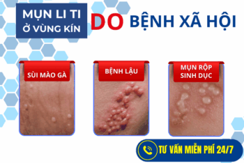 Nổi Mụn Cóc Ở Vùng Kín Nam: Có Phải Dấu Hiệu Bệnh Xã Hội