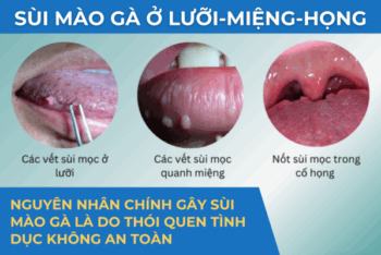 TÌM HIỂU BỆNH SÙI MÀO GÀ Ở LƯỠI, MIỆNG, HỌNG VÀ CÁCH CHỮA HIỆU QUẢ