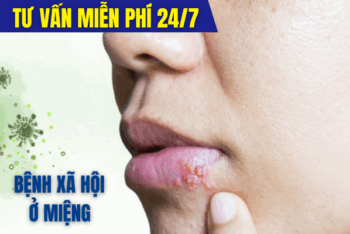 Triệu Chứng Bệnh Xã Hội Ở Miệng Có Nguy Hiểm Không?