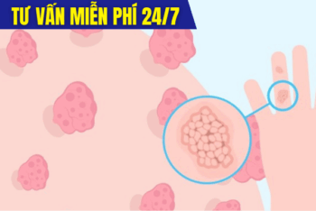 Hình Ảnh Sùi Mào Gà Và Các Giai Đoạn Bệnh Lý